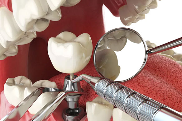 Имплантация зубов в стоматологии Медсервис Бьюти